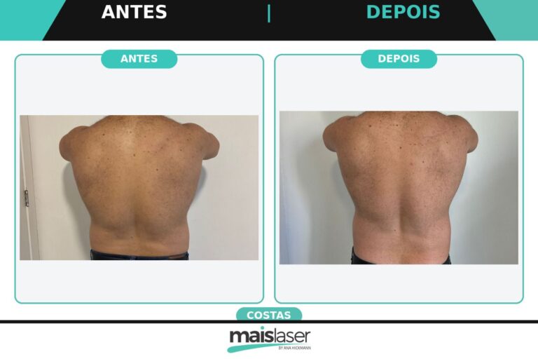 Costas - 2 sessões