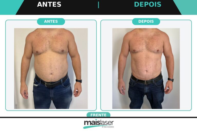 Frente - 2 sessões